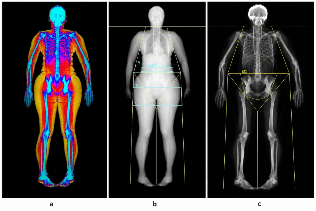 estudo-aponta-relacao-entre-gordura-abdominal-e-maior-risco-de-perda-urinaria-em-mulheres